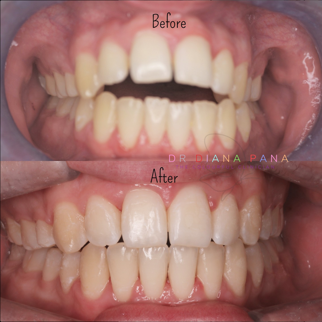 before and after dental treatment patient comparison